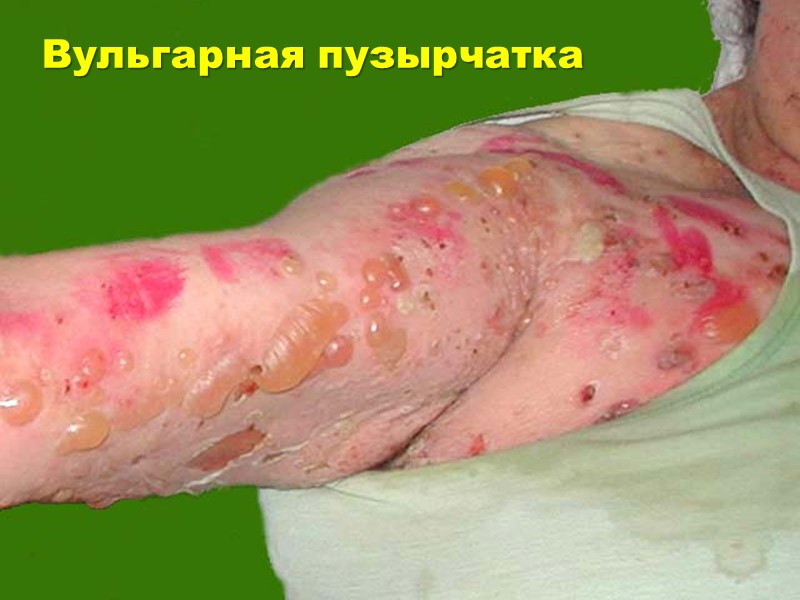 Вульгарная пузырчатка